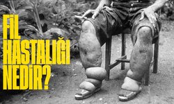 Fil Hastalığı Nedir? Belirtileri, Nedenleri ve Tedavi Yöntemleri