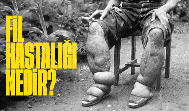 Fil Hastalığı Nedir? Belirtileri, Nedenleri ve Tedavi Yöntemleri