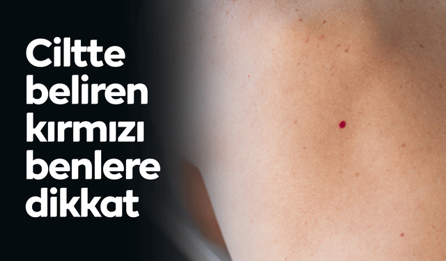 Ciltte beliren kırmızı benlere dikkat