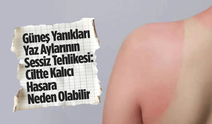 Güneş Yanıkları Yaz Aylarının Sessiz Tehlikesi: Ciltte Kalıcı Hasara Neden Olabilir
