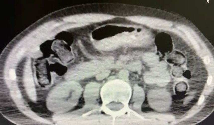 Midelerinde uyuşturucu sevkiyatı yapan 2 torbacı tutuklandı